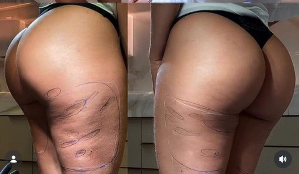 Antes e depois coxa de Isabelle Nogueira — Foto: Reprodução/Instagram