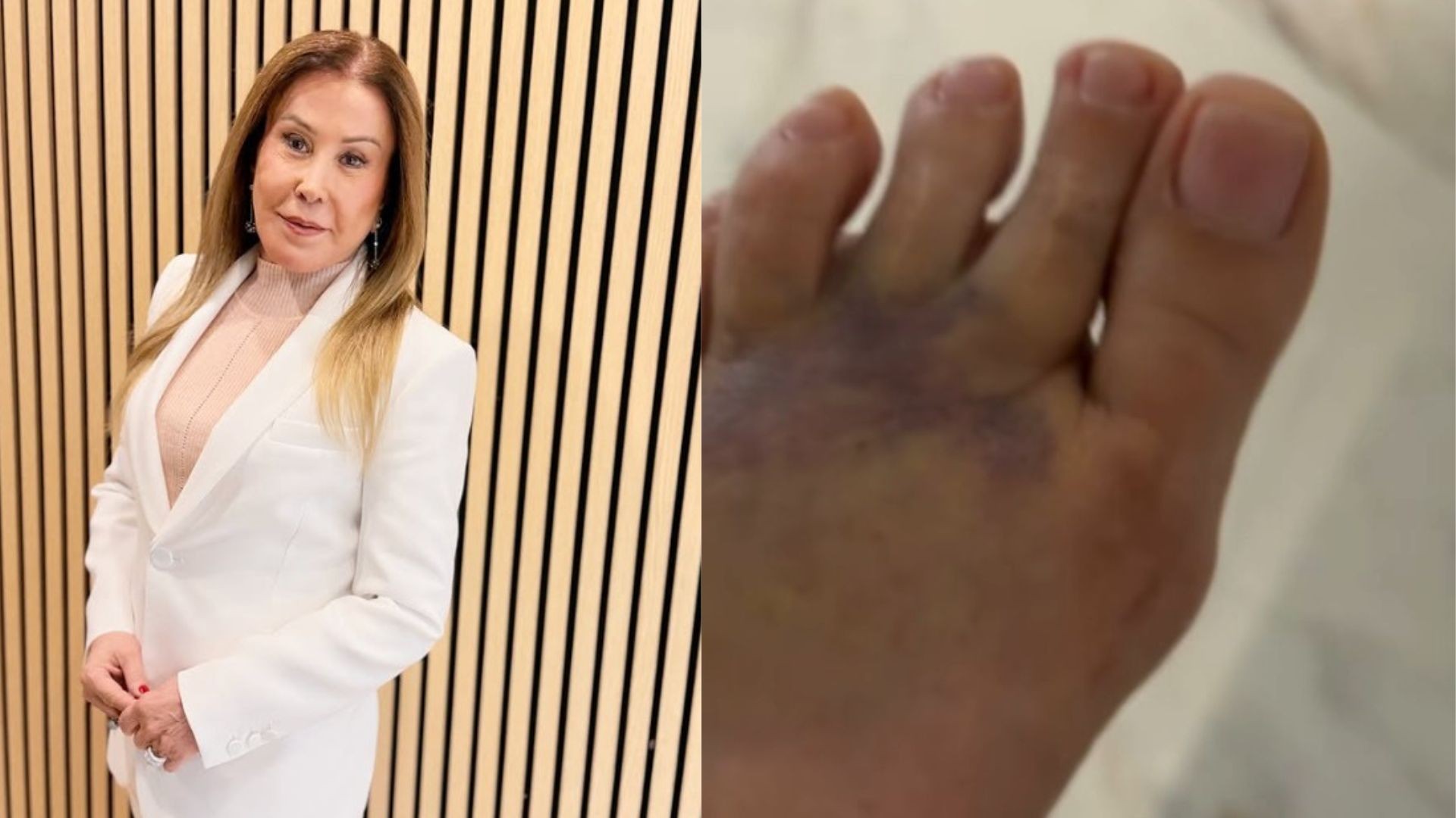 Zilu Camargo desabafa após cair de escada e fraturar o pé: 'Falta de cuidado'