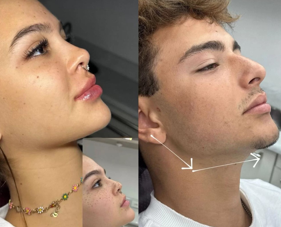 Mel Maia e o namorado da atriz, João Maria Pereira, aderiram à perfiloplastia — Foto: Reprodução/Instagram