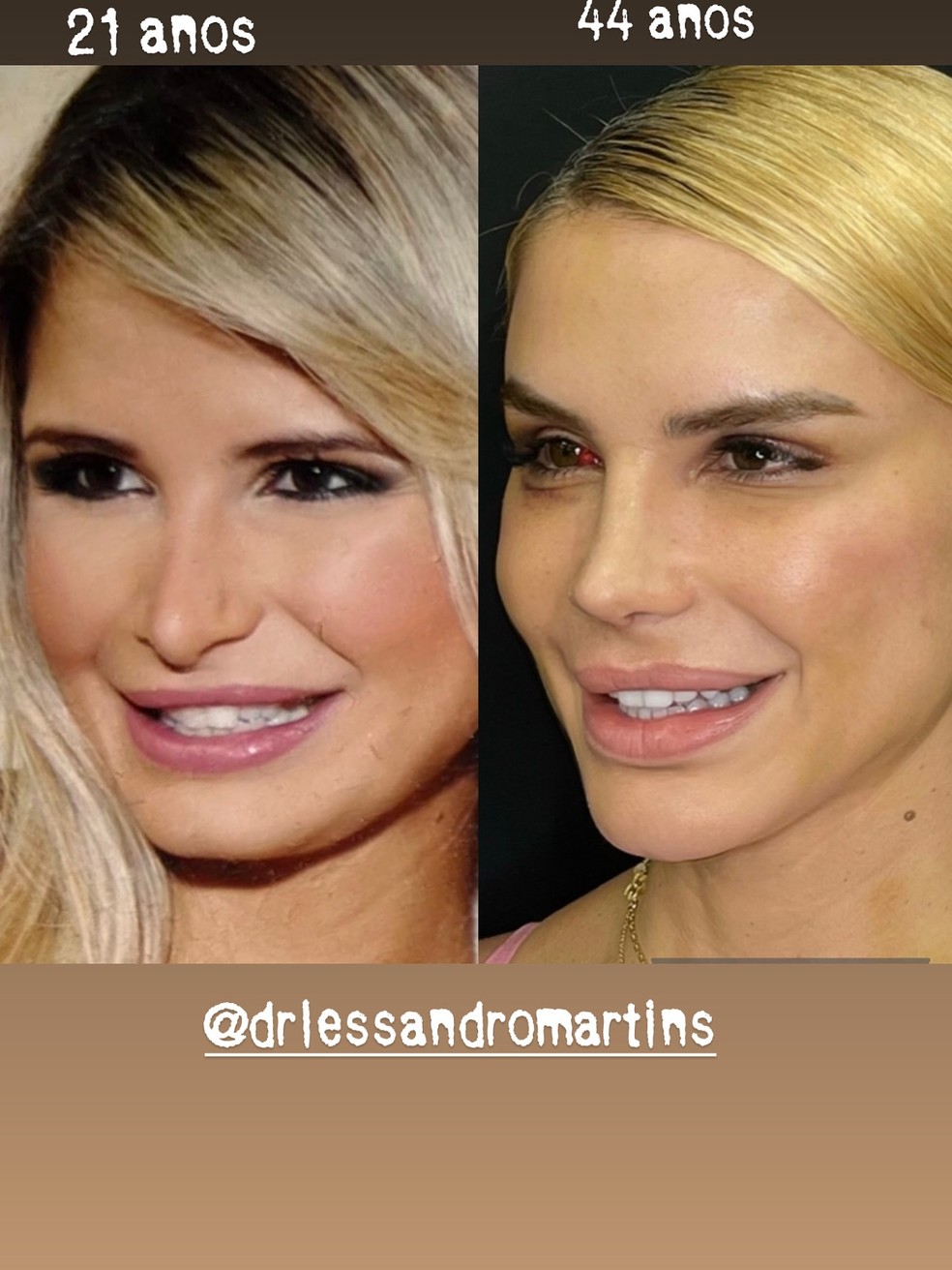 Pricylla Pedrosa antes e depois da rinoplastia — Foto: Reprodução Instagram