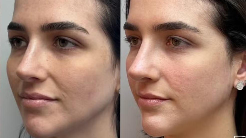 Duda Fournier fez harmonização facial — Foto: Instagram