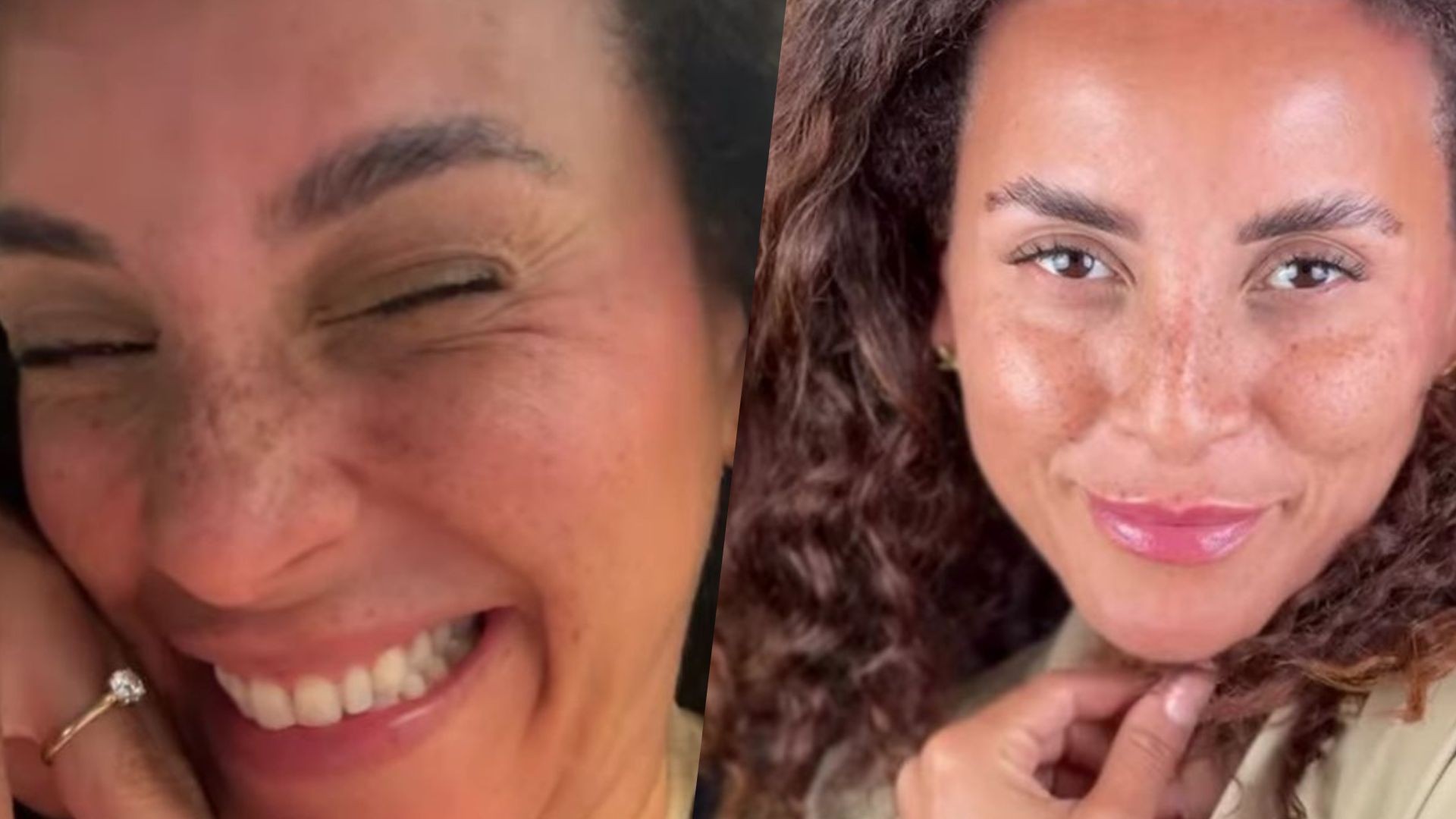 Ex-BBB Domitila Barros faz procedimentos estéticos e mostra resultados; veja antes e depois