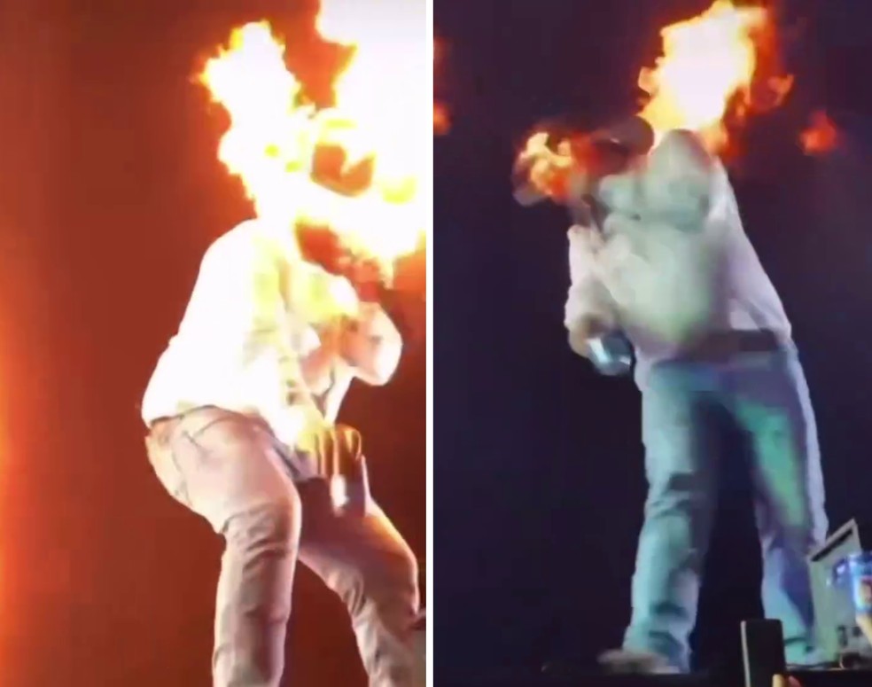 Queimaduras no rosto do sertanejo Léo — Foto: Reprodução/Redes Sociais