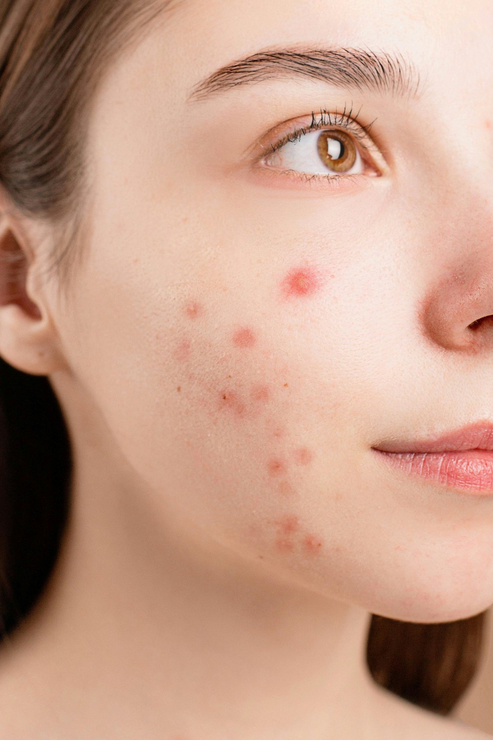 Acne na mulher adulta: quais as possíveis causas, cuidados e tratamentos? — Foto: Pexels/Reprodução