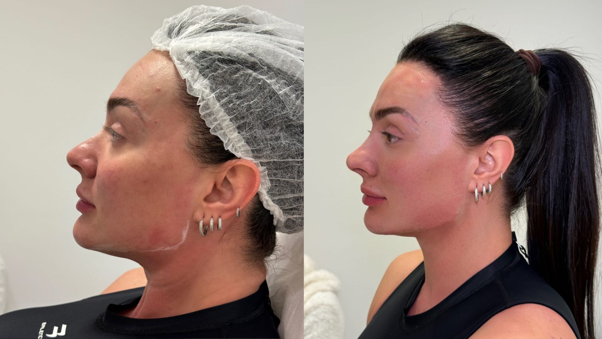 Juju Salimeni surpreende com antes e depois de procedimentos estéticos