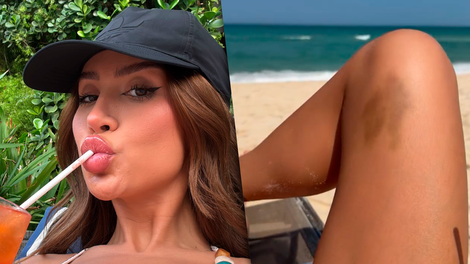 Bianca Andrade mostrando hematoma na perna direita durante dia de praia