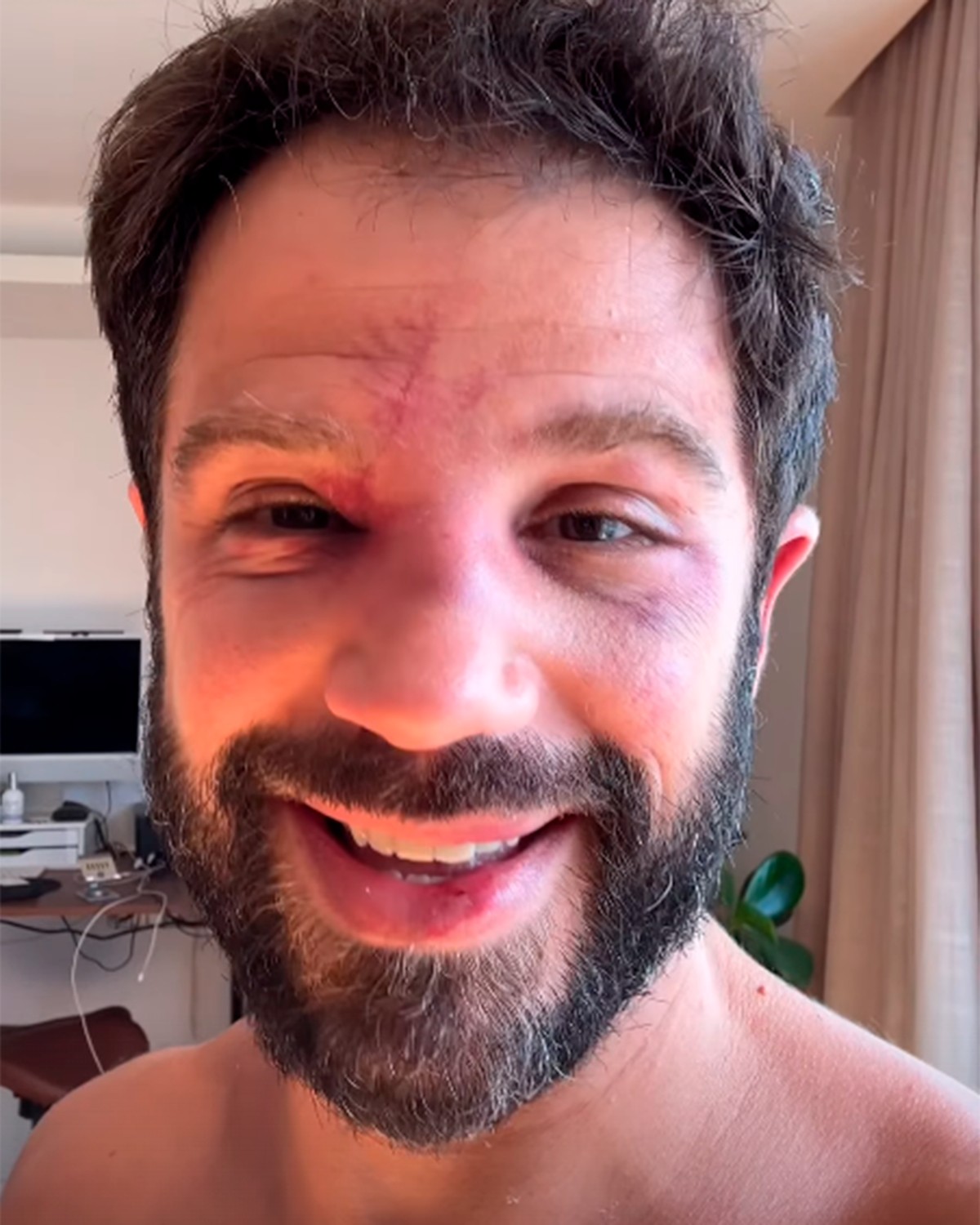 Duda Nagle aparece com rosto cheio de hematomas após perder luta para ...