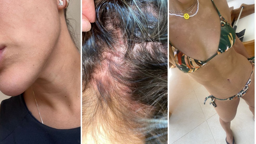 Registros de momentos em que Renata Saldanha enfrentou uma crise da doença — Foto: Acervo/Divulgação