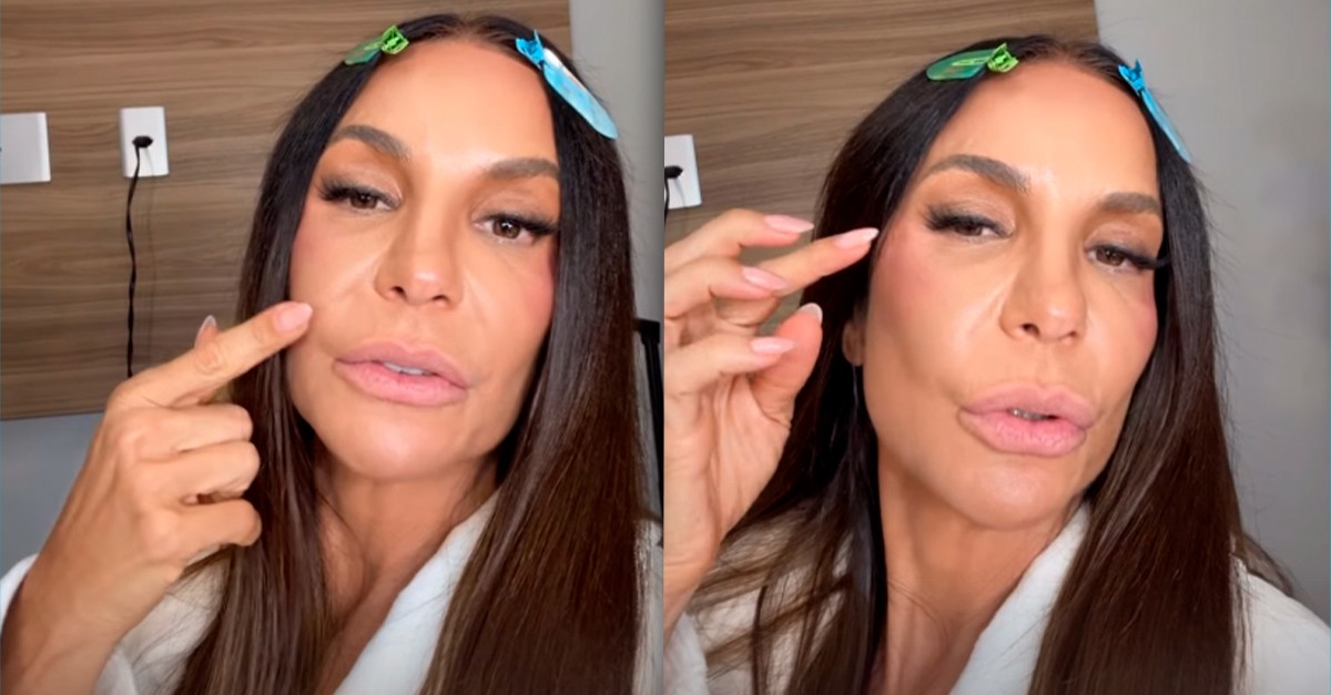 Ivete Sangalo revela que está com presilhas de titânio no rosto após fratura: 'Ainda sinto um pouco de dormência'