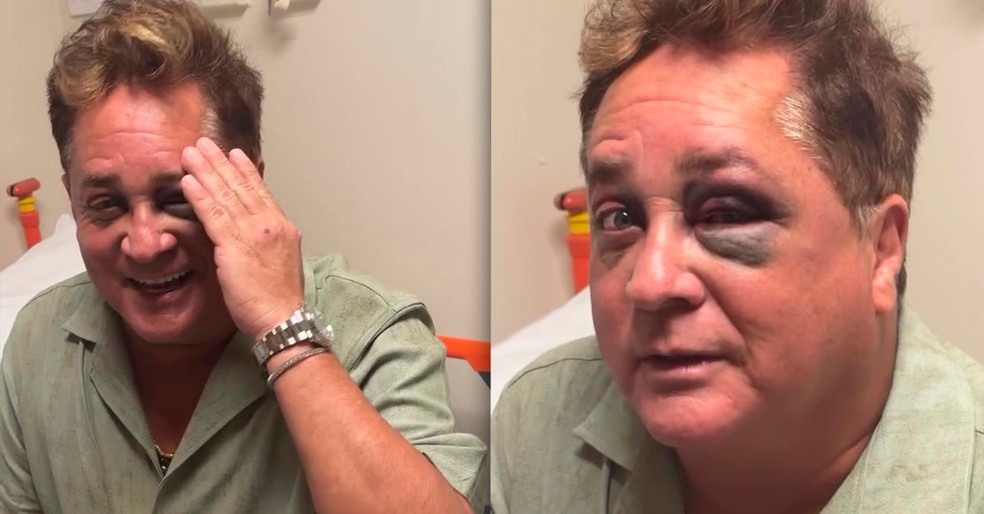 Leonardo passa sufoco em pesca e mostra olho roxo no hospital — Foto: Instagram