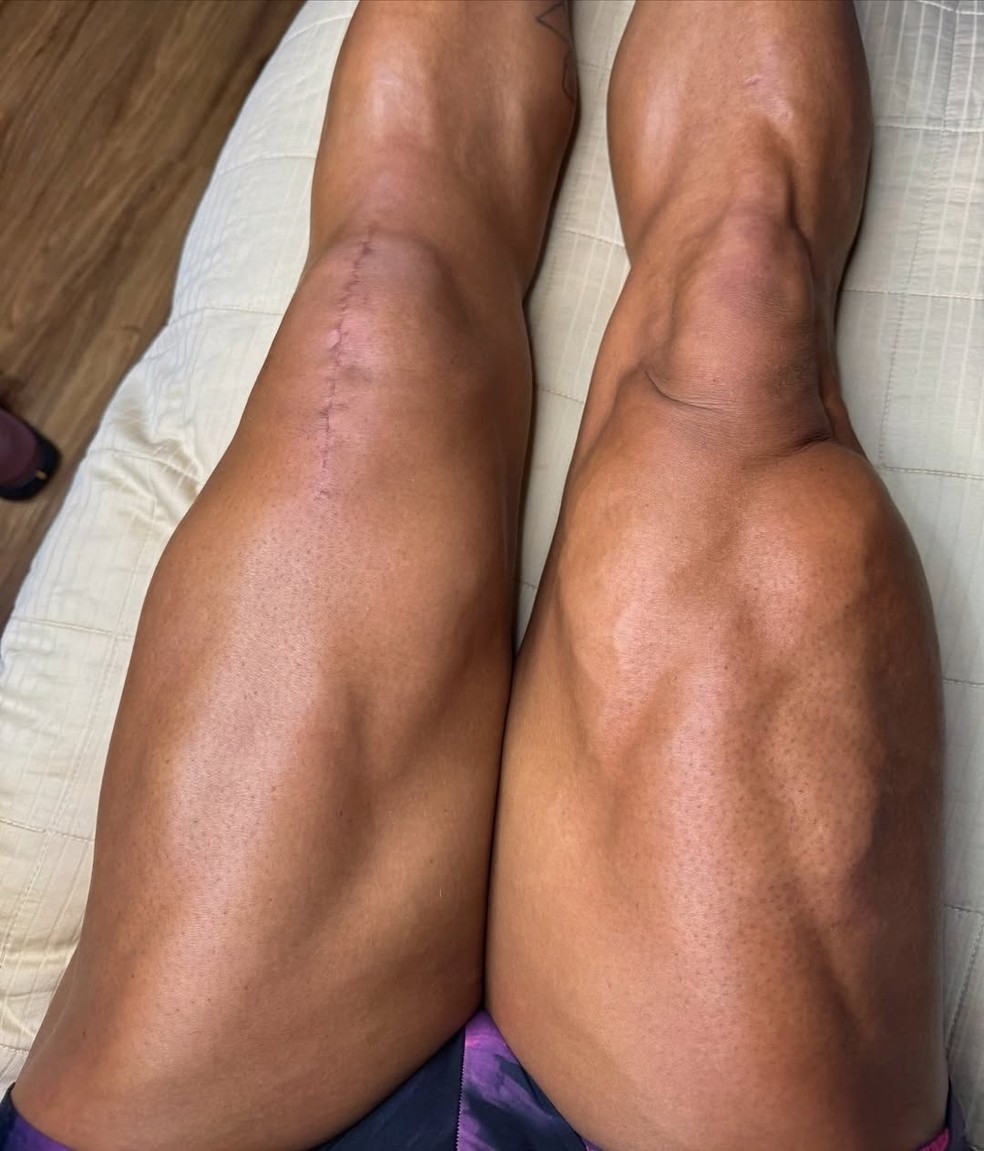 Gracyanne Barbosa exibe cicatriz no joelho — Foto: Reprodução/Redes sociais