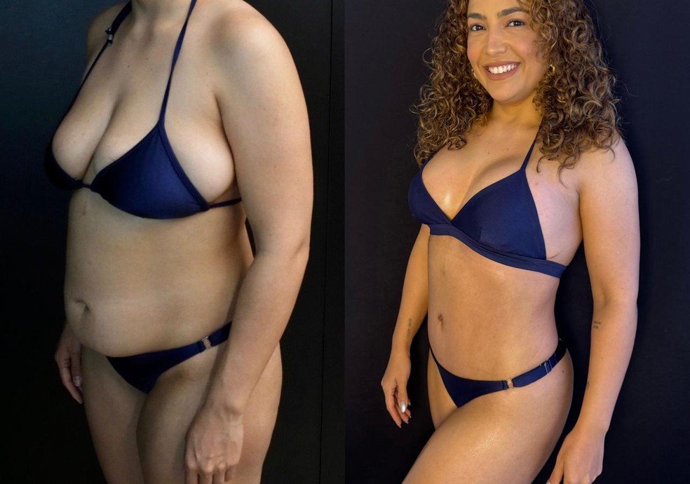 Camila Moura antes e depois da cirurgia plástica — Foto: Divulgação