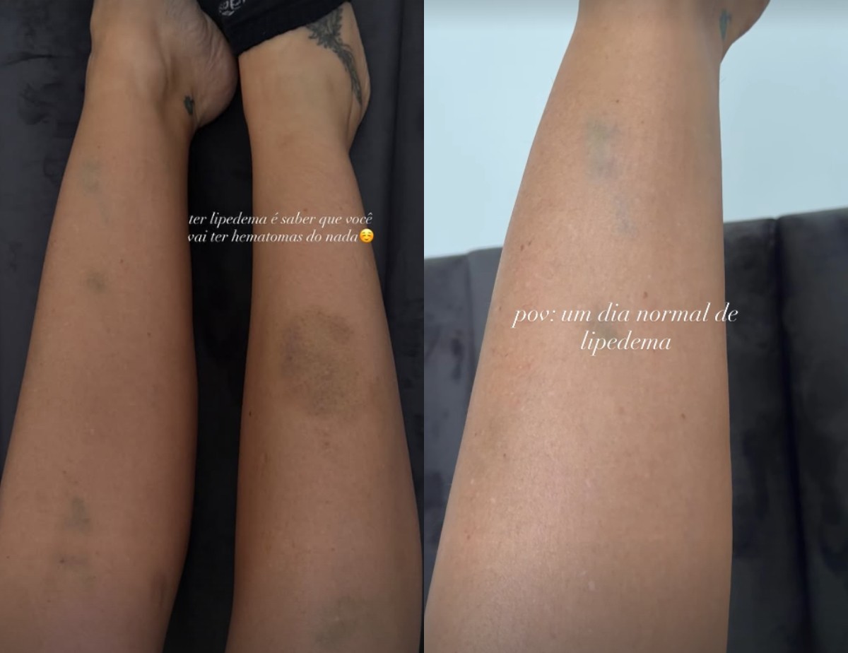 Yasmin Brunet mostra hematomas nas pernas causados pelo lipedema