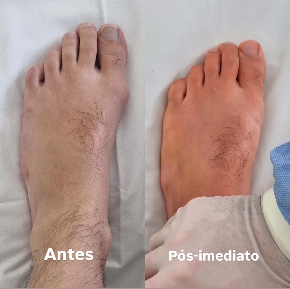 Eliezer mostro o pós-cirurgia — Foto: Reprodução/Insatgram