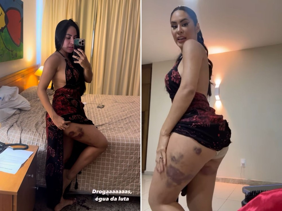 Isabelle Nogueira mostra hematomas na perna após procedimento estético para retirada de celulites — Foto: Reprodução/Instagram