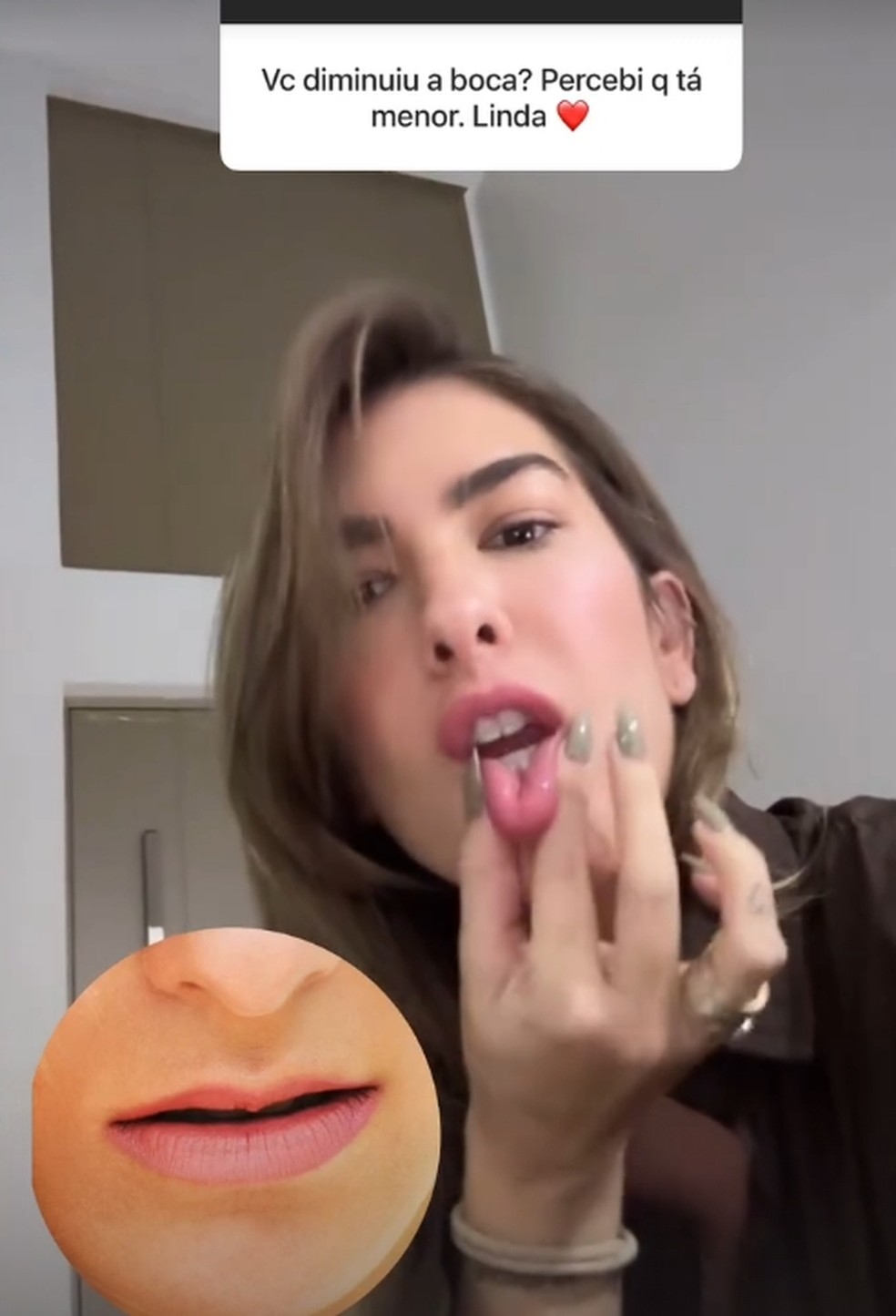Lore Improta mostra antes e depois do preenchimento labial — Foto: Reprodução/Instagram