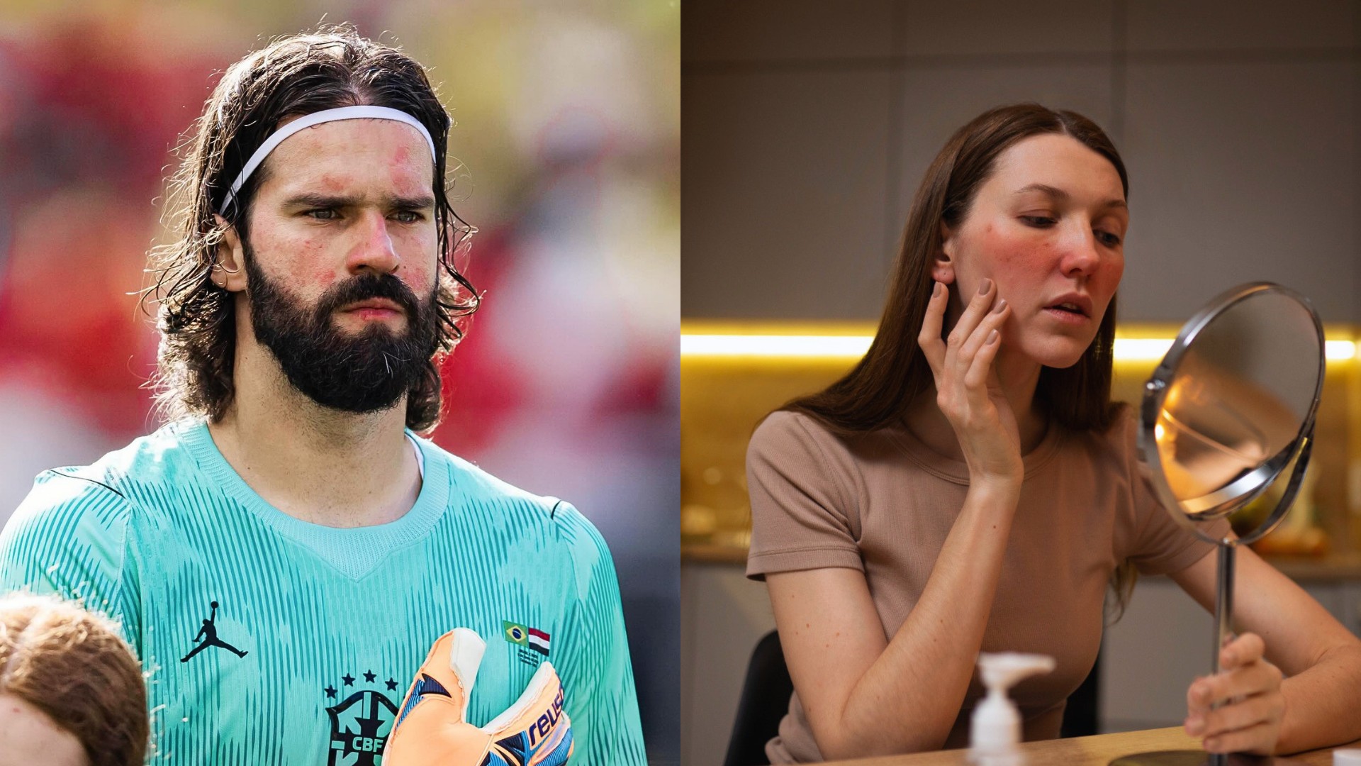 Rosácea: entenda a vermelhidão no rosto de Alisson Becker e como funciona o tratamento