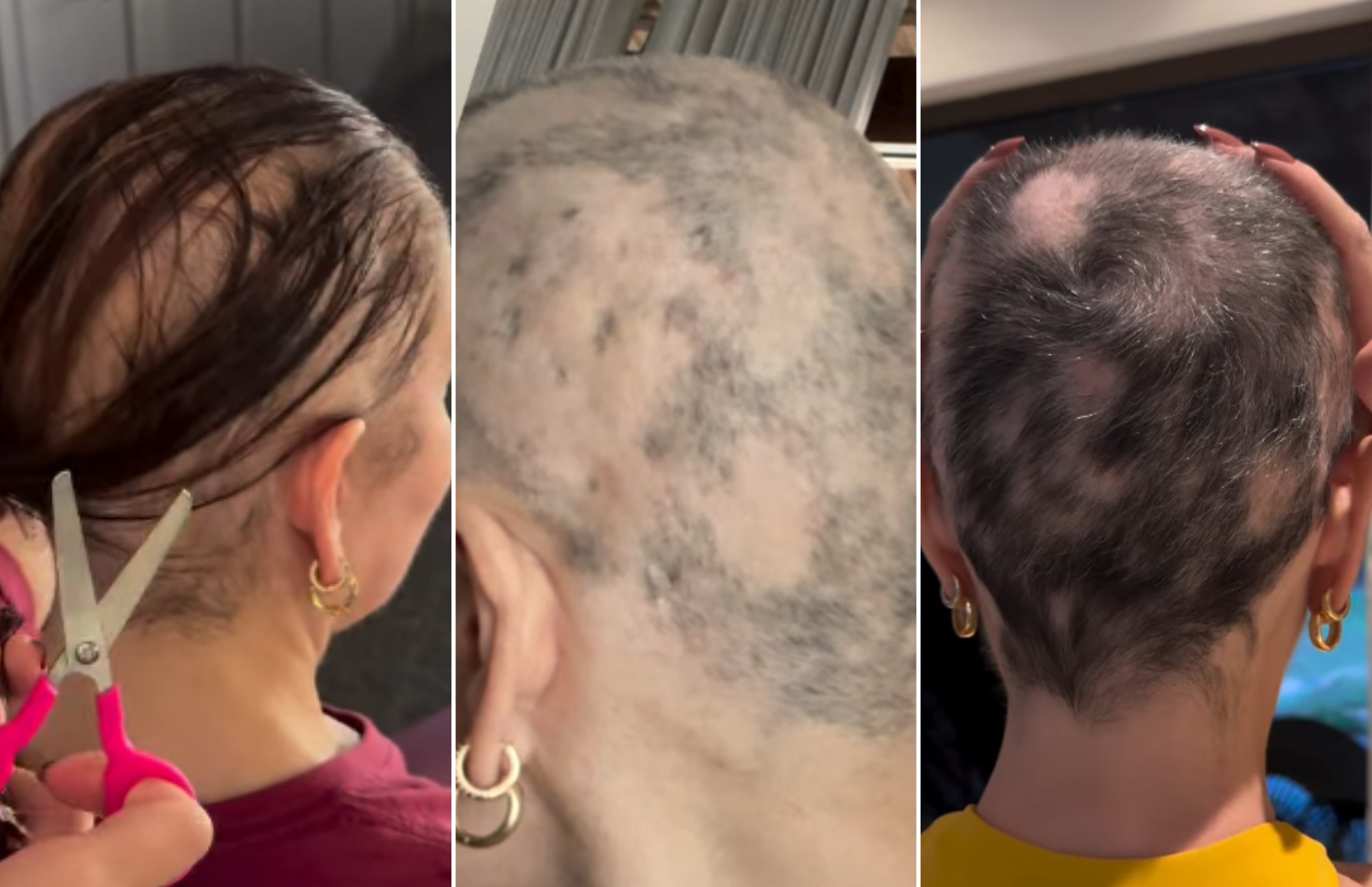 Mãe de Luccas Lucco, Karina, mostra o antes e depois do tratamento da alopecia