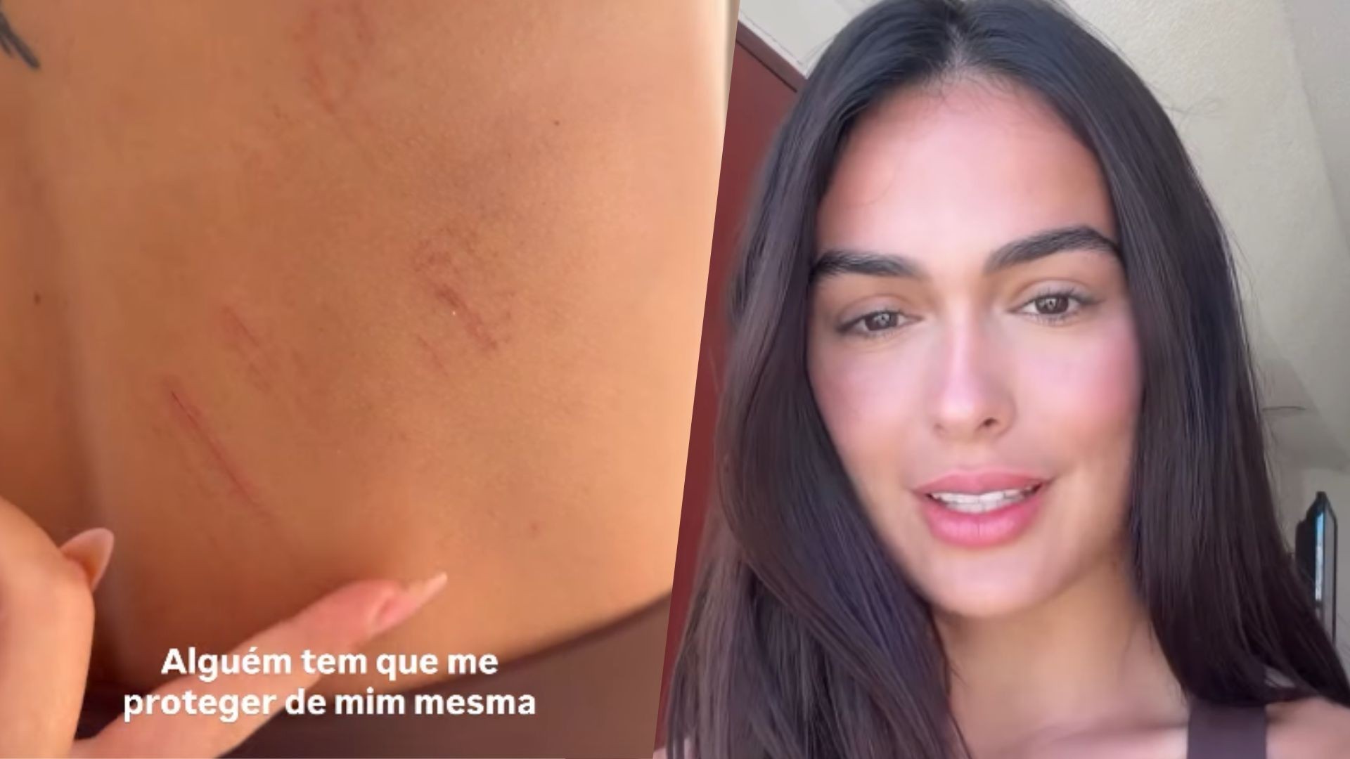 De férias, Larissa Santos leva tombo, exibe costas machucadas e brinca: 'Alguém tem que me proteger de mim'