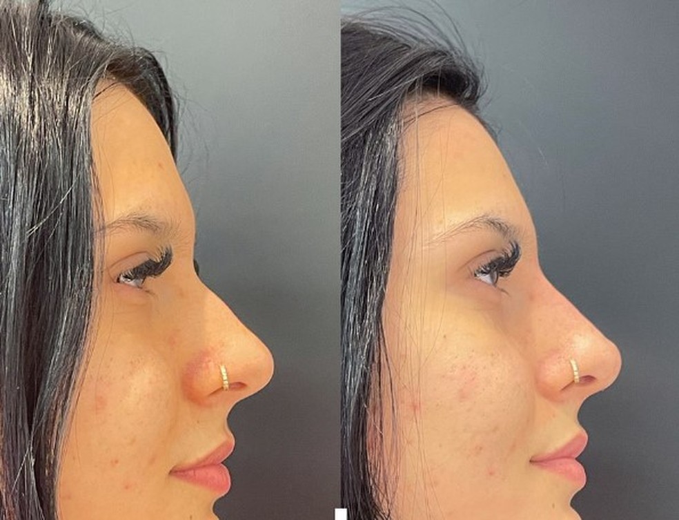 Antes e depois do nariz de Ana Castela — Foto: Reprodução Instagram