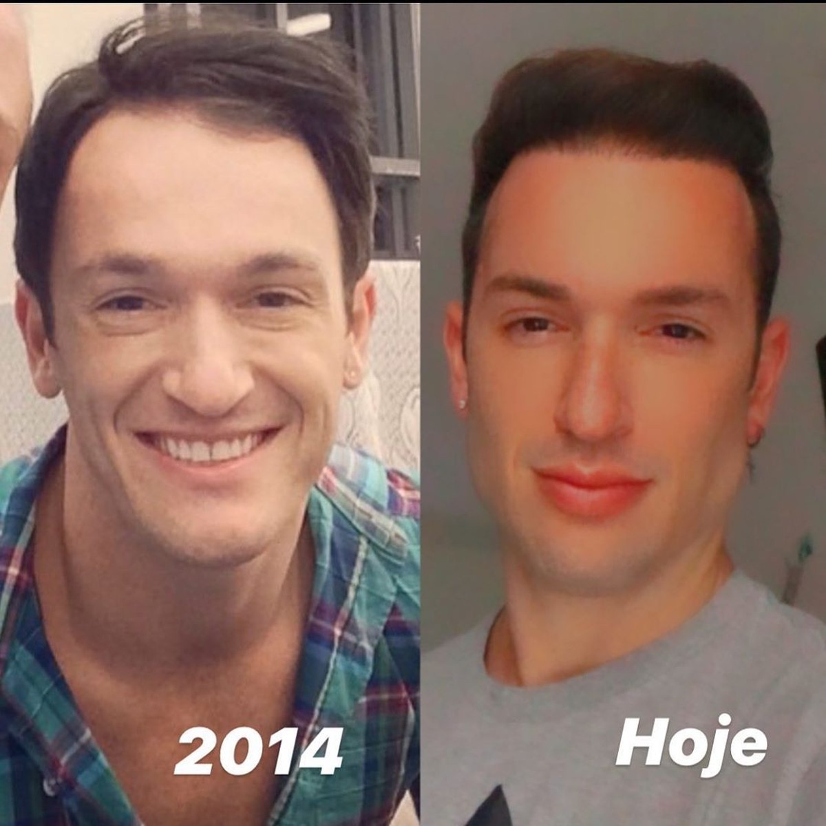 Diego Hypolito posta 'antes e depois' e lista procedimentos estéticos ...