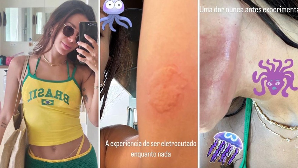 Anitta sofre queimadura por água-viva em Ibiza e relata maior dor da vida — Foto: Reprodução/Instagram