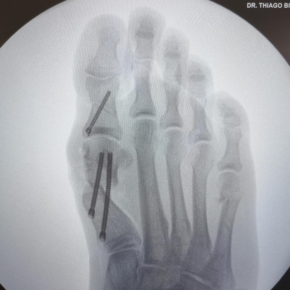 Eliezer mostra raio-x do procedimento feito no pé — Foto: Reprodução/Instagram