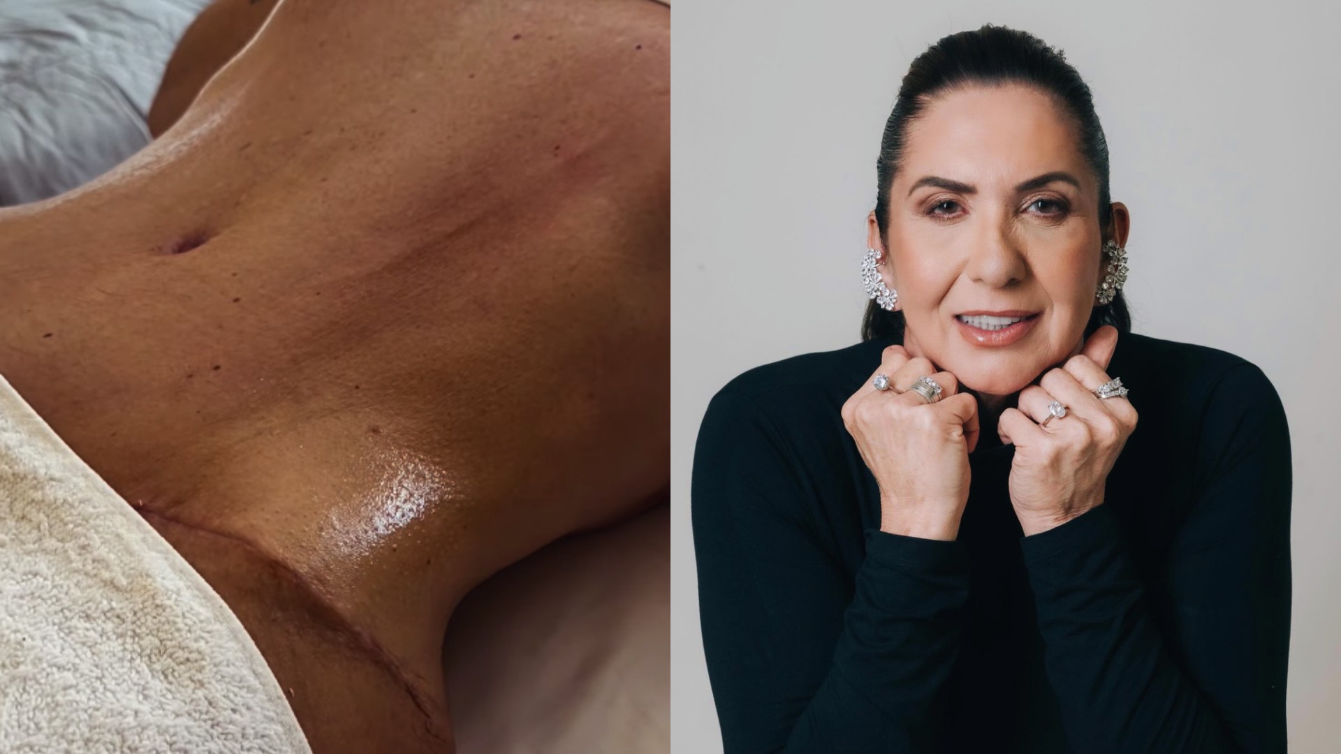 Margareth Serrão, mãe de Virginia, impressiona com resultado de cirurgia plástica