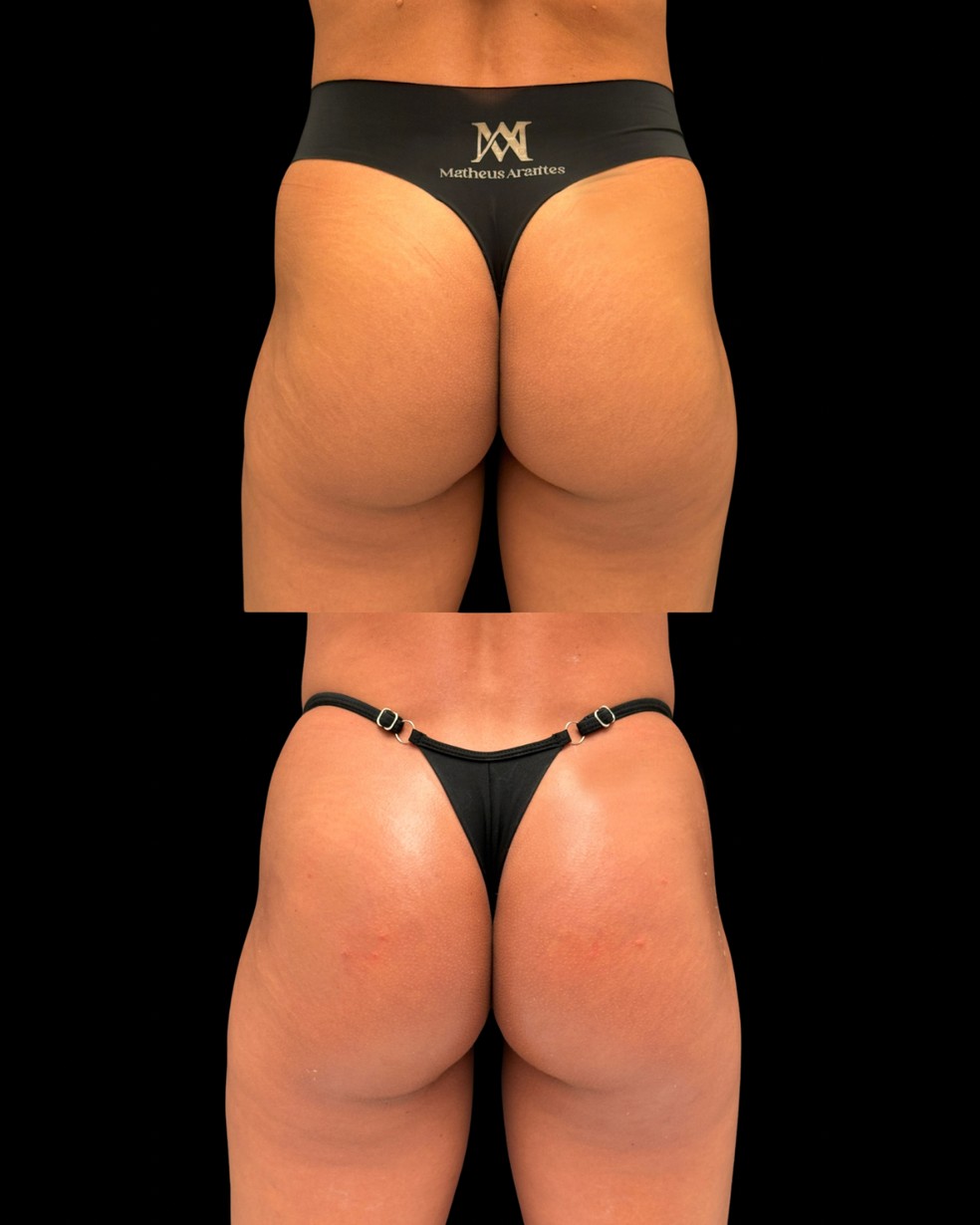 Veja antes e depois do procedimento de glúteos de Maxiane — Foto: Arquivo pessoal