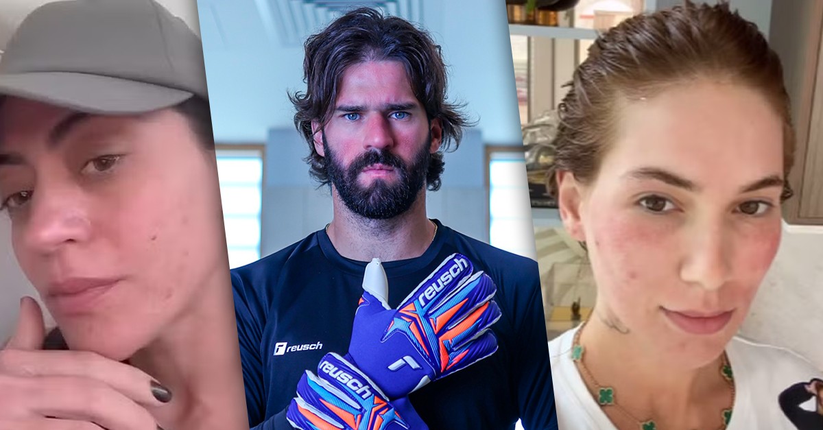 Virginia, Carol Castro e outros famosos têm rosácea, mas o que é? Especialista explica!