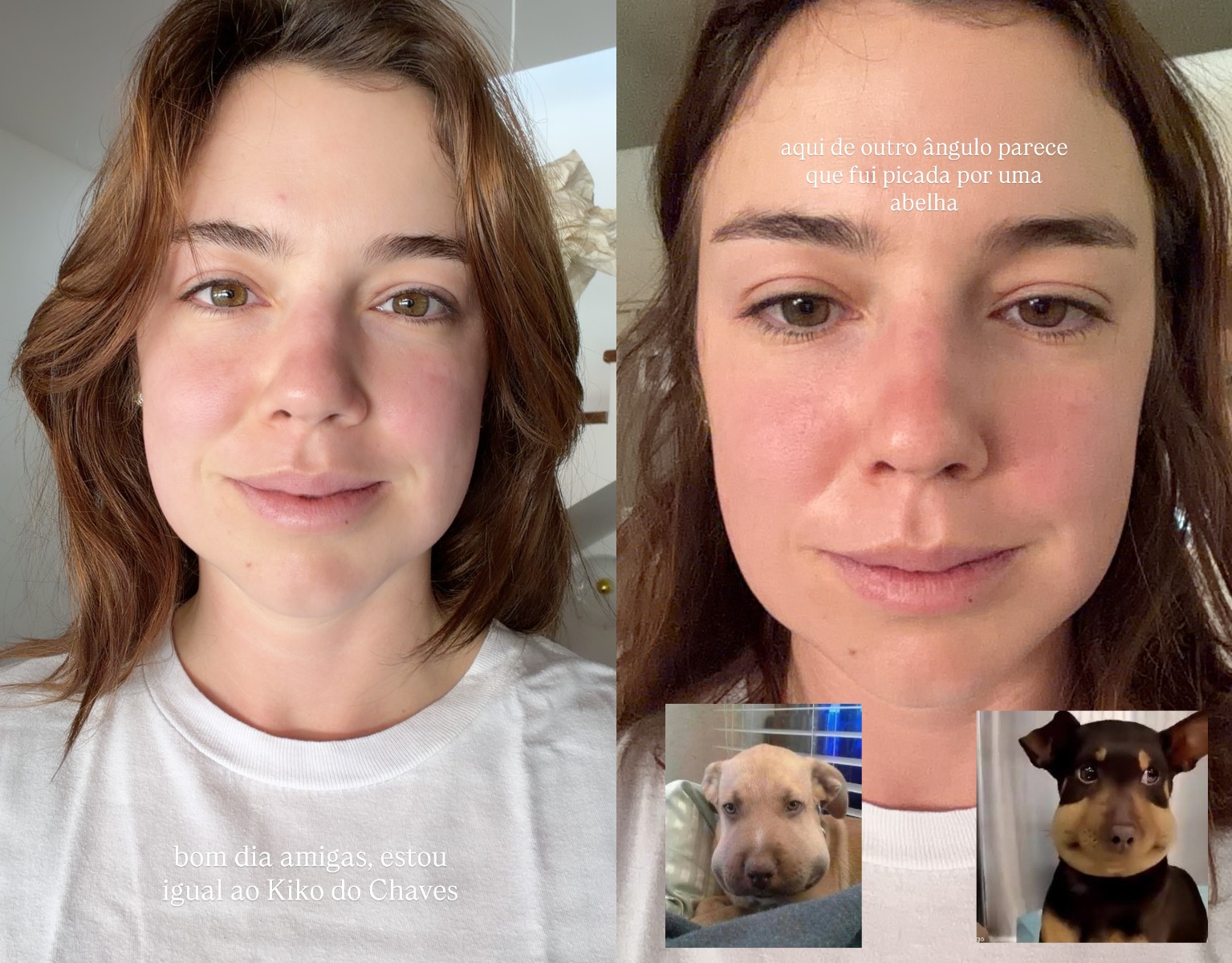 Alice Wegmann mostra inchaço após procedimento: 'Pareço o Quico, do Chaves'