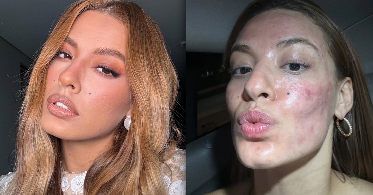 Beatriz Reis compartilha foto de tratamento na pele do rosto: 'Não consigo fazer sempre'