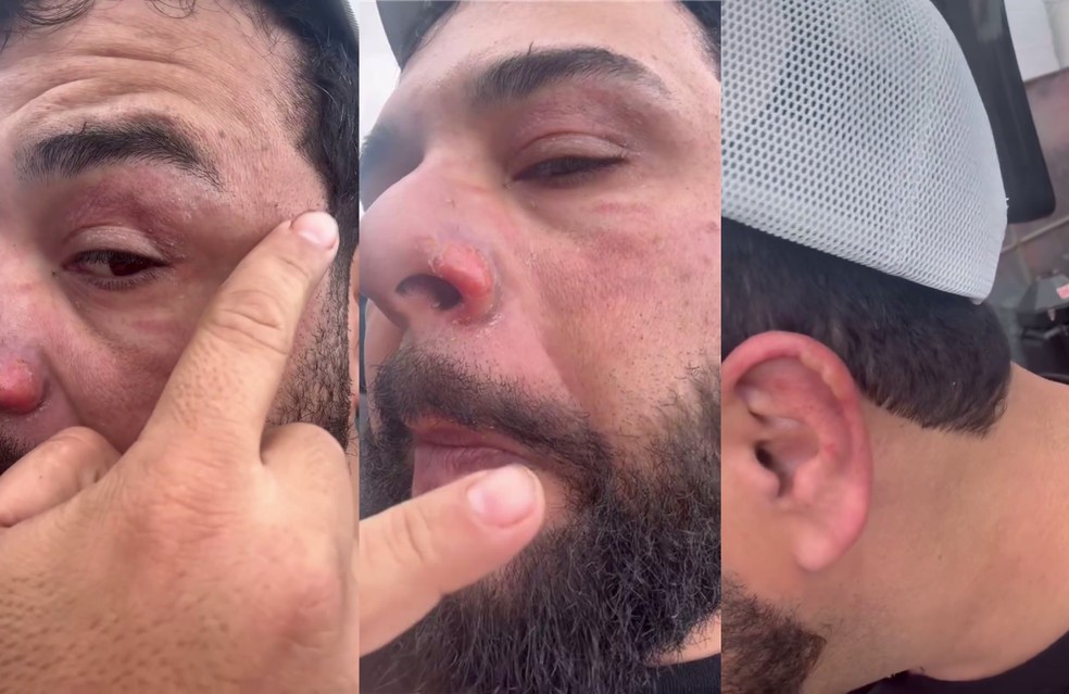 Queimaduras no rosto do sertanejo Léo — Foto: Reprodução/Redes Sociais