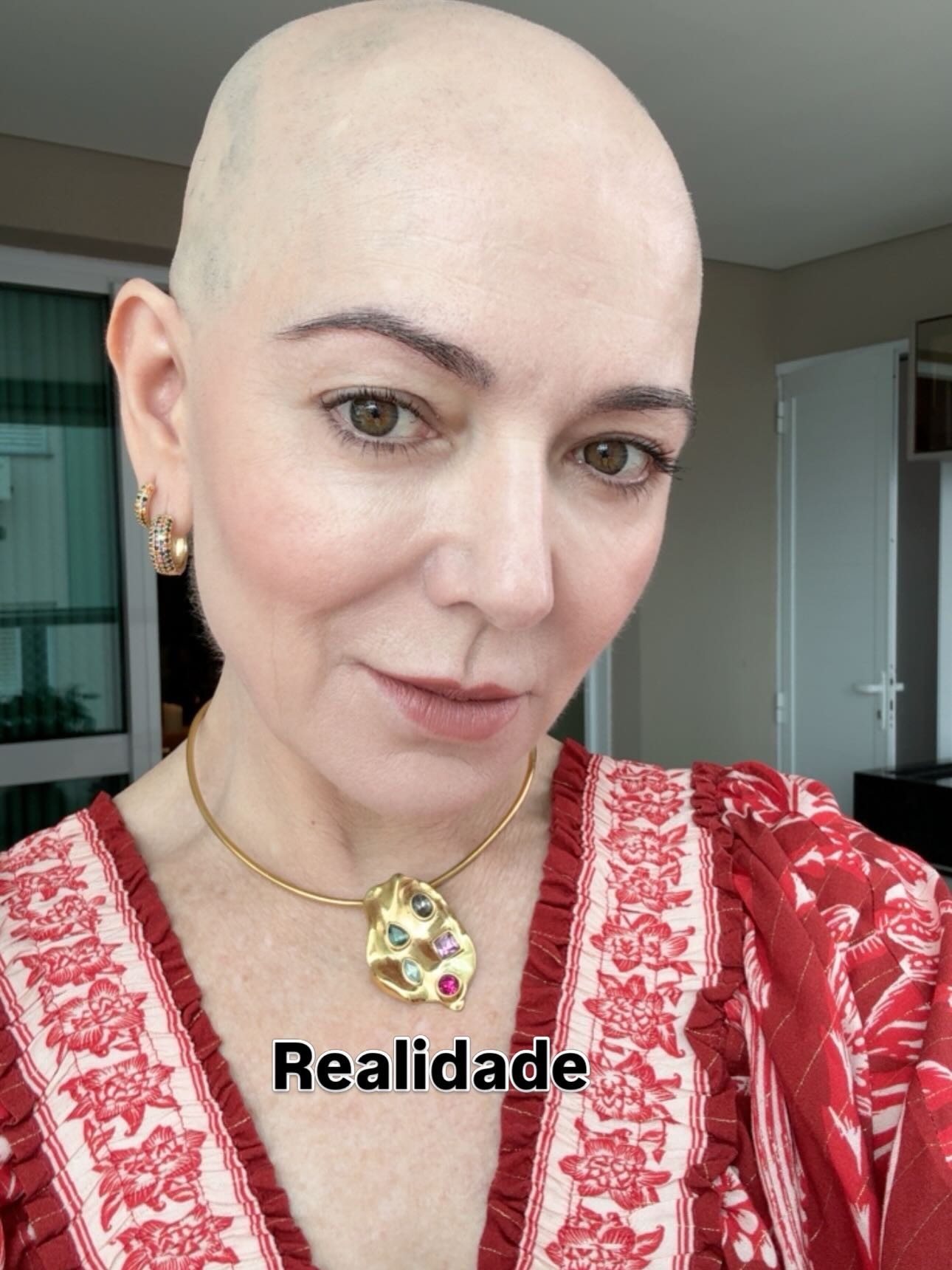 Mãe de Lucas Lucco fala da decisão de assumir cabeça raspada e agradece apoio: 'Reflete no meu tratamento'