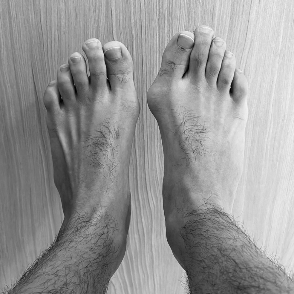 Pé de Eliezer com joanete — Foto: Reprodução/Instagram