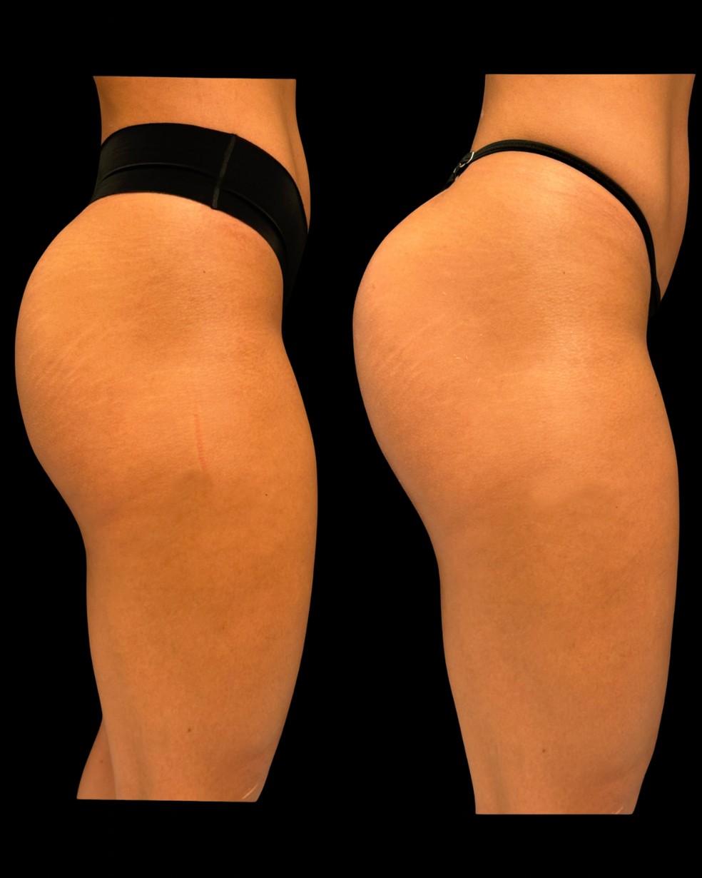 Veja antes e depois do procedimento de glúteos de Maxiane — Foto: Arquivo pessoal