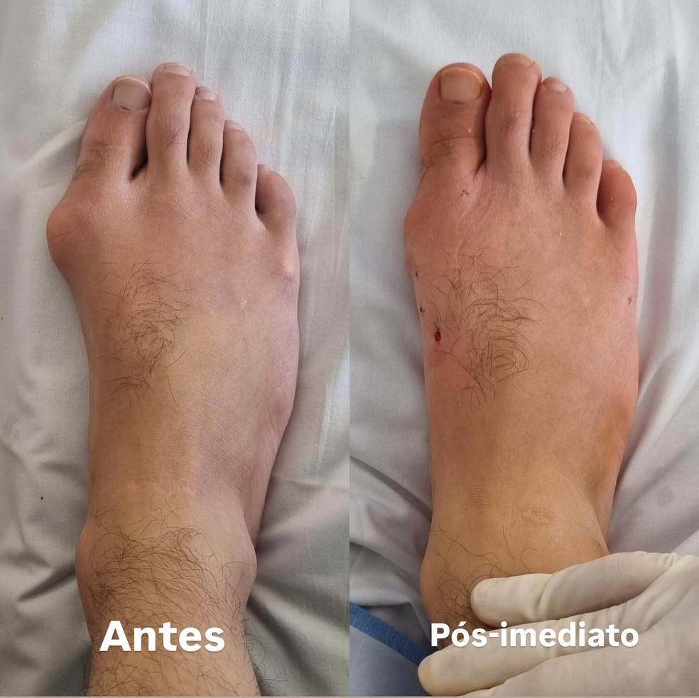 Veja o antes e depois do pé de Eliezer — Foto: Reprodução/Instagram