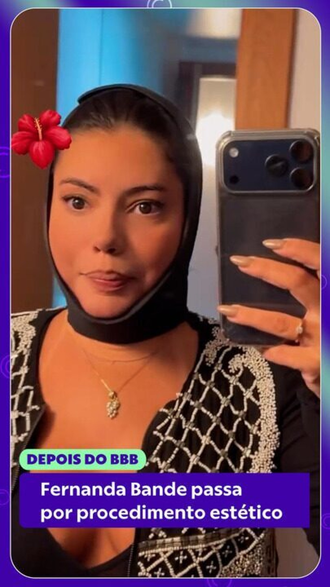 Fernanda Bande passa por procedimento estético: 'Rosto super inchado, mas dei um jeito'