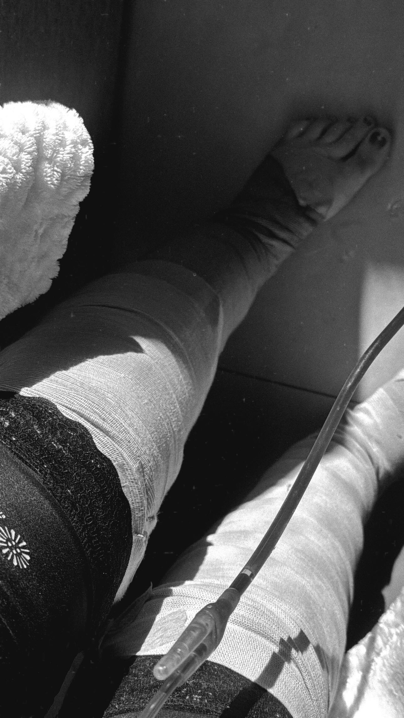 Após realizar cirurgia de lipedema, Amanda Meirelles fala de recuperação