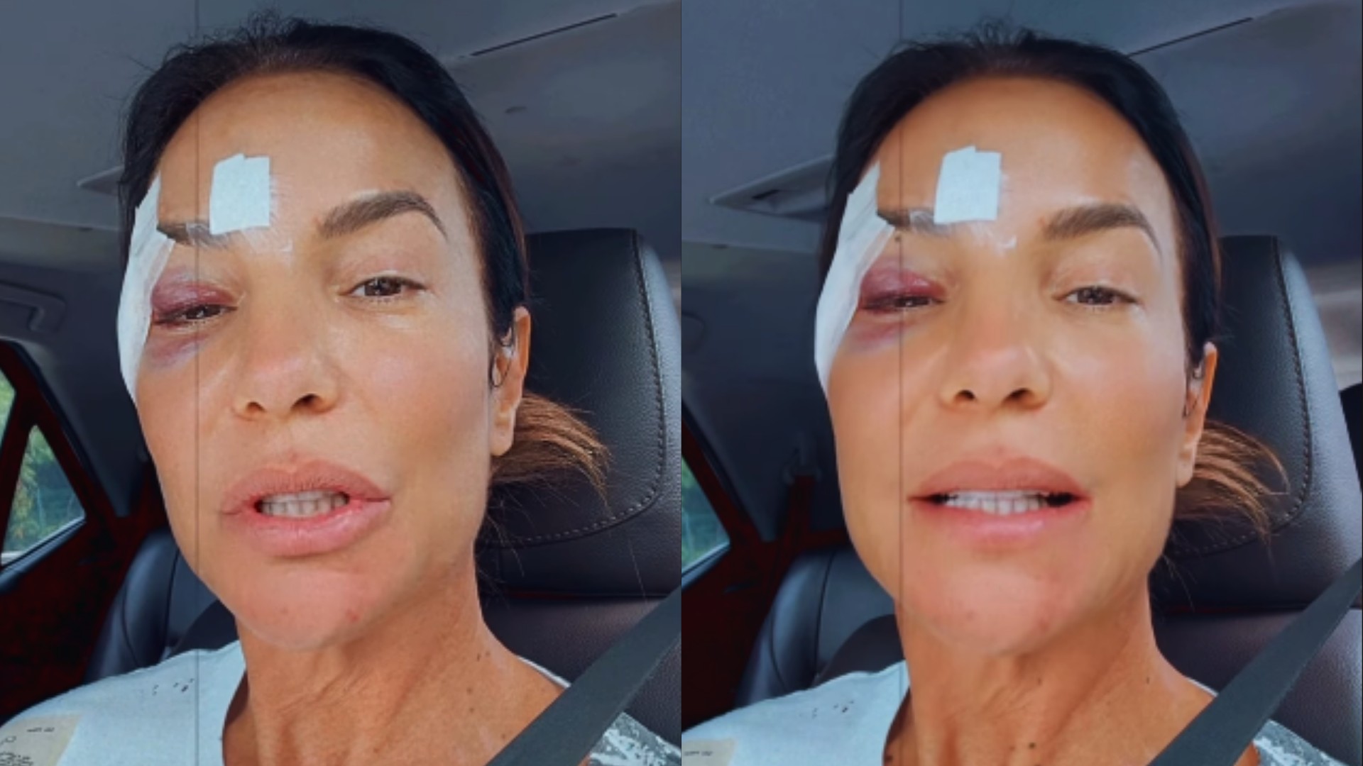 Ivete Sangalo recebe alta médica após desmaio e surge com hematoma no olho; veja vídeo