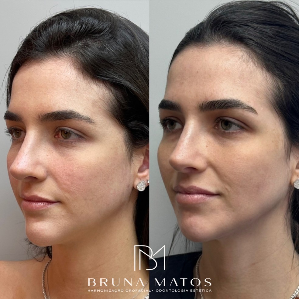 Duda Fournier fez harmonização facial — Foto: Reprodução/Instagram