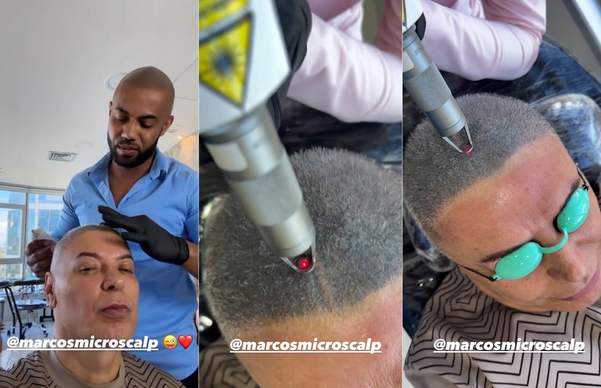 David Brazil tenta consertar micropigmentação no couro cabeludo que ficou 'verde' em vez de marrom