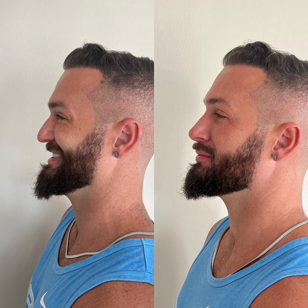 Diego Hypolito mostra antes e depois de procedimentos estéticos, e brinca: 'Jogo dos sete erros' — Foto: Reprodução/Instagram