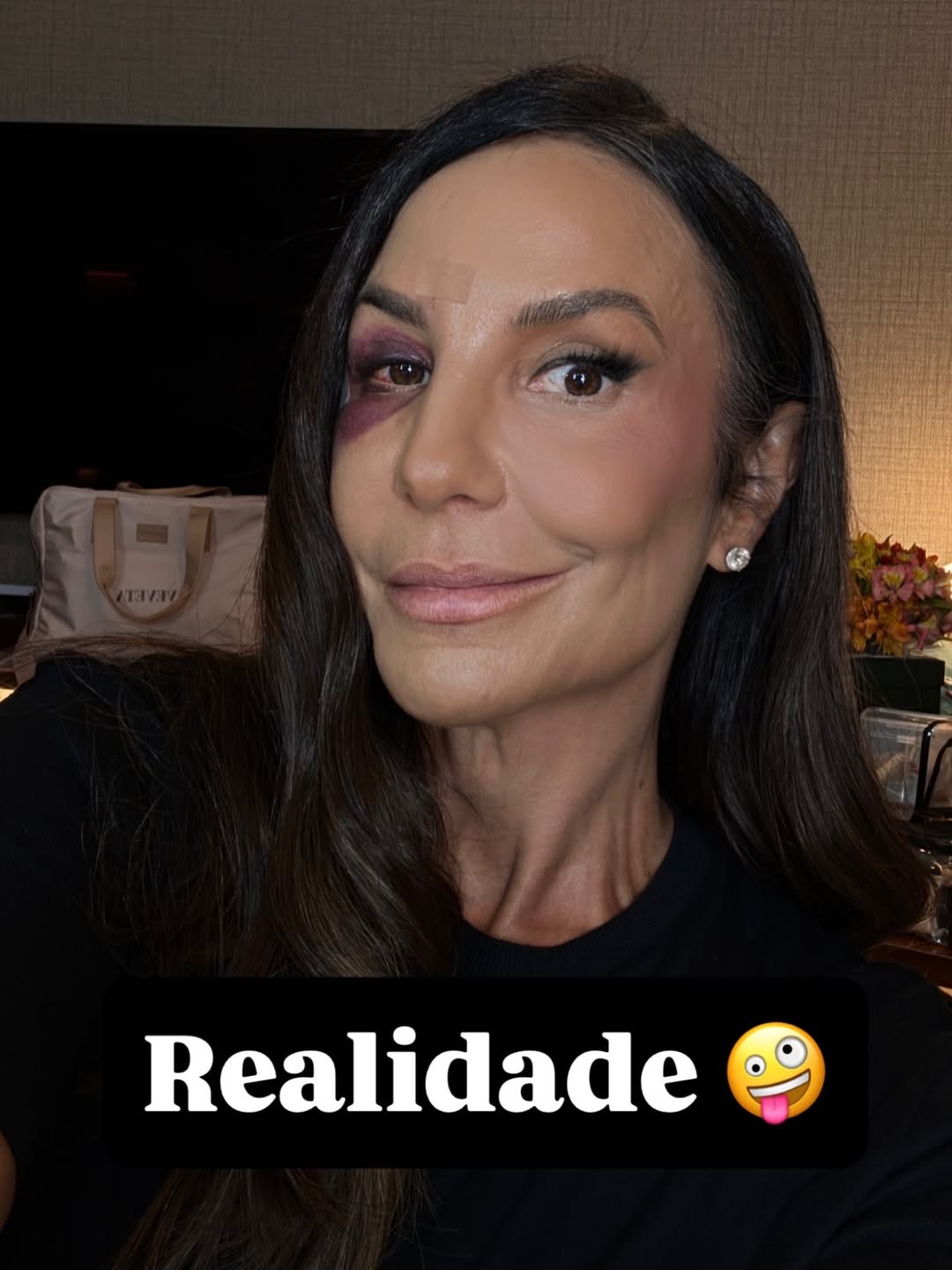 Ivete Sangalo brinca com hematoma no rosto: expectativa x realidade